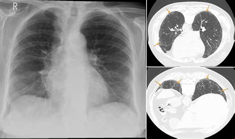 Interstitial lung disease - UIP - Radiology at St. Vincent's University ...