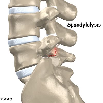 Spondylolisthesis Scotty Dog