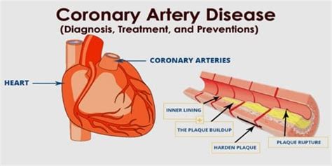 Coronary artery disease (Diagnosis, Treatment, and Preventions ...