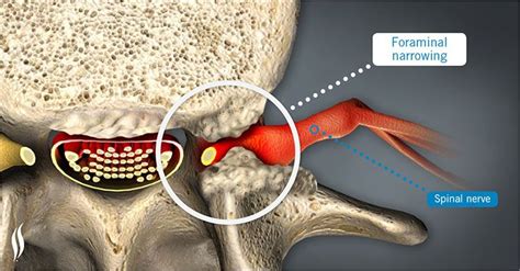 Spinal Narrowing | Foraminal Narrowing | Spinal Stenosis | Stenosis ...