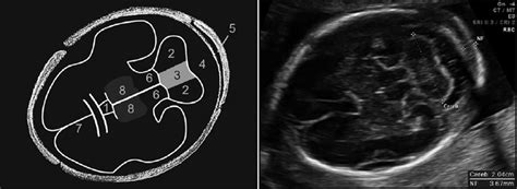 Fetal Head - The ObG Project