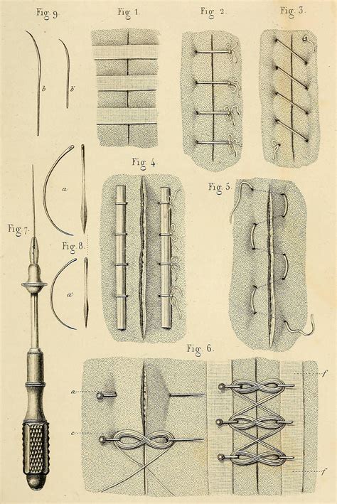 Wound closure techniques ca. 1855. Fig 1. Closure of the wound without sutures, using adhesives ...