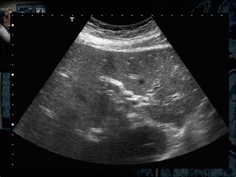 Figure 5 from Ultrasound periportal cuffing: differential diagnosis | Semantic Scholar