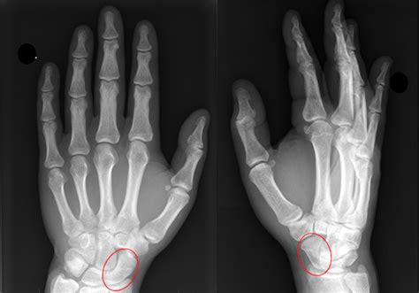 Scaphoid fracture