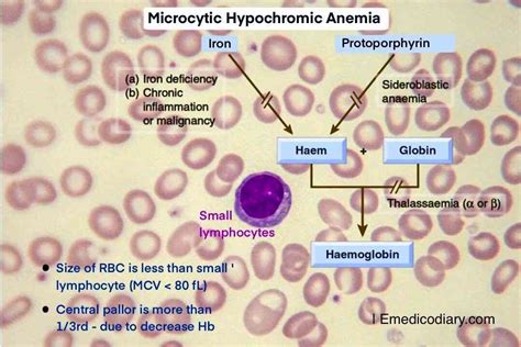 Microcytic hypochromic anemia - Emedicodiary