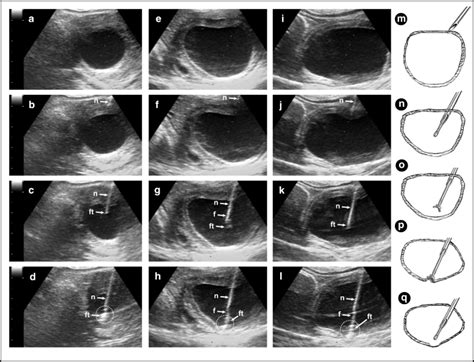 In vivo antral follicle wall biopsy: a new research technique to study ovarian function at the ...