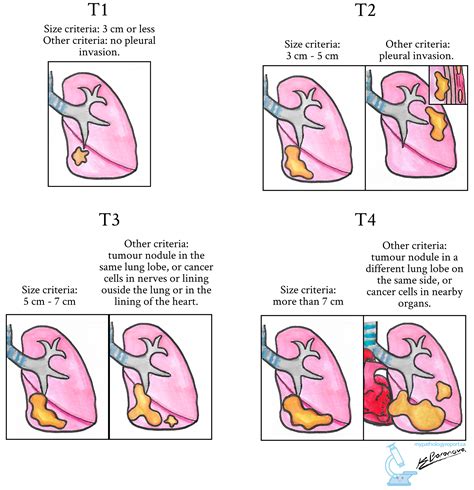 Adenocarcinoma of the lung | MyPathologyReport.ca