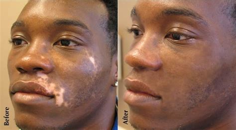 Vitiligo Treatment by MicroArt Semi Permanent Makeup