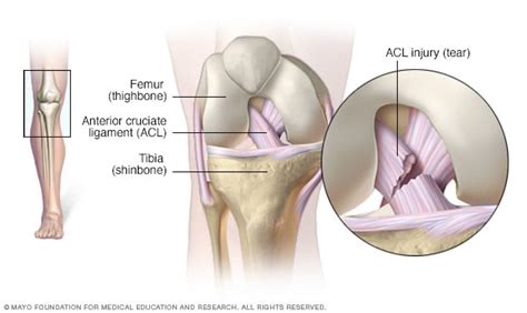 Swollen knee - Symptoms and causes - Mayo Clinic