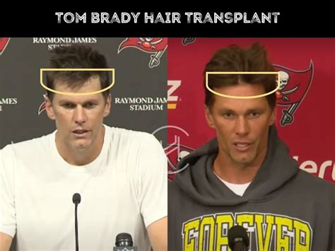 Tom Brady Hair Transplant - Hair Loss & Technical Analysis