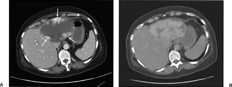 Hepatic Hemangioma Ultrasound