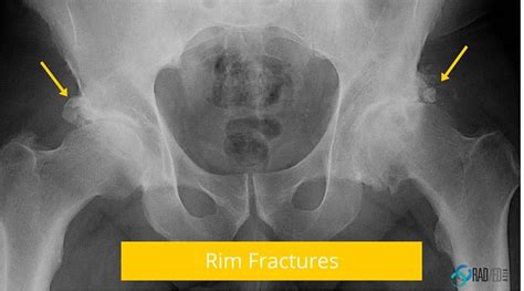 Hip MRI ? Show me the Xray: Acetabular Rim Ossifications. How to make ...