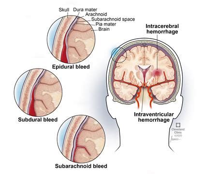 INTRACRANIAL HAEMORRHAGE - Living Tower Medical Services