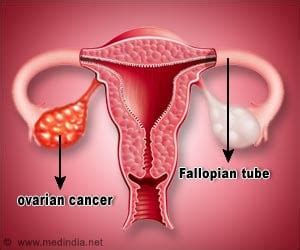 Fallopian Tube Removal may Cut Ovarian Cancer Risk