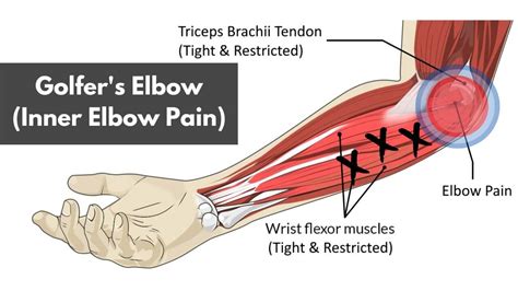 A Helpful Guide to Golfer's Elbow (Inner Elbow Pain)