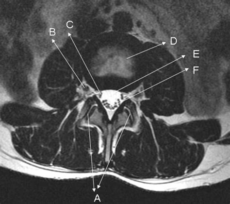 Abnormal Lumbar Spine Axial Mri