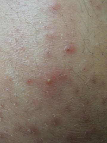 Folliculitis: Causes, Symptoms, Treatment, 53% OFF