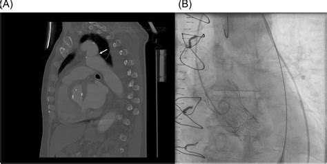 (A) Pseudo‐coarctation of the tortuous thoracic aorta just distal to ...