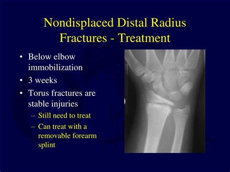 Distal radius torus fracture treatment - Lasiwar