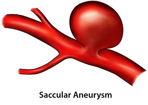 Storm Anesthesia - Brain Aneurysm - Basics