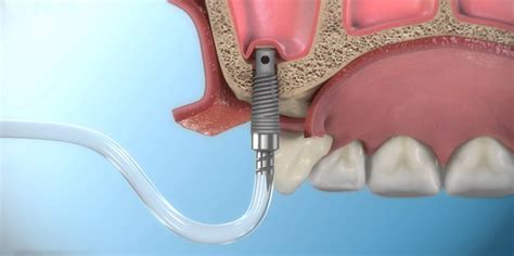 Sinus Lift - SmileBox Dental Clinic คลินิกทันตกรรมสไมล์บ็อกซ์