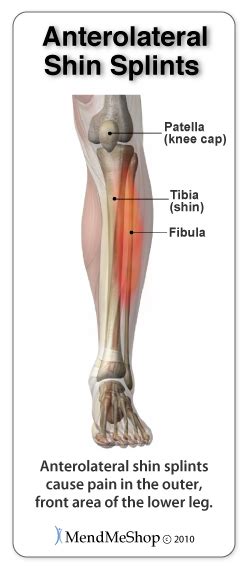 Shin Splints - Fleet Feet Hickory