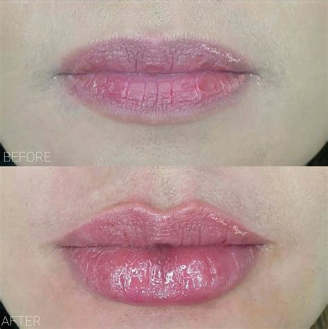 LIP AUGMENTATION • CONTOURING & RESHAPING | Lip fillers, Lip enhancement, How to line lips