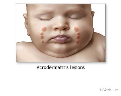 Papular Acrodermatitis Of Childhood