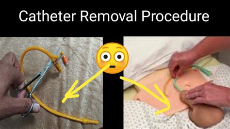 How To Remove Catheter With Scissors || Catheter Removal Procedure || How to Cut Catheter - YouTube