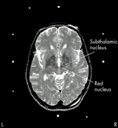 Subthalamus Mri