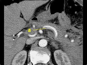 Abdomen and retroperitoneum | 1.7 Peritoneum mesentery and omentum ...