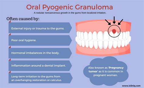 Oral Pyogenic Granuloma - Causes | Diagnosis | Treatment | Prevention