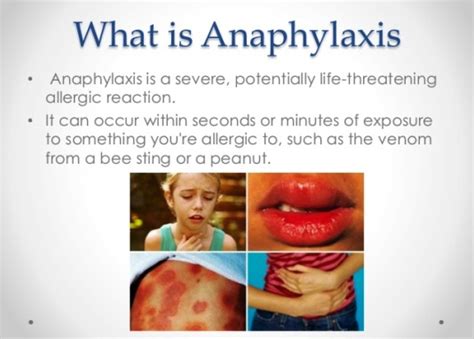 Anaphylaxis, An Overview - Health And Medical Information