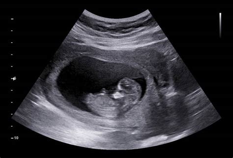 6 Things To Consider Before Getting A Private Ultrasound Scan