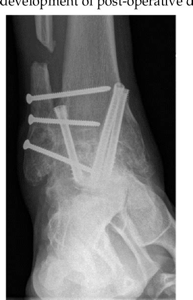 Figure 3 from Does Concurrent Distal Tibiofibular Joint Arthrodesis Affect the Nonunion and ...