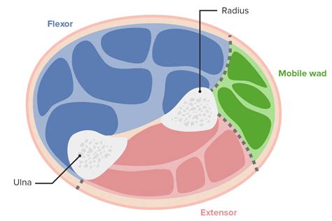 Compartment Syndrome | Concise Medical Knowledge