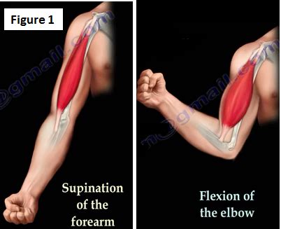 Popeye Deformity | HuffPost Life