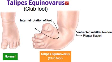 club foot - talipes equinovarus - peds - Rosh Review | Medical mnemonics, Pediatrics, Nursing school