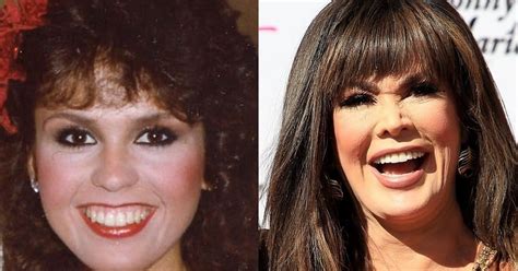 Marie Osmond Without Makeup Look: Plastic Surgery Before And After