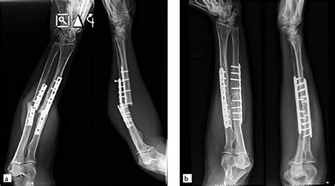 27 Radius and Ulna Shaft Fractures | Musculoskeletal Key