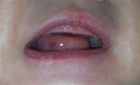 purple spot on tongue? - BabyCenter