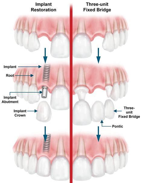 Dental Bridge - Procedure, Dental Bridge Vs Dental Implant