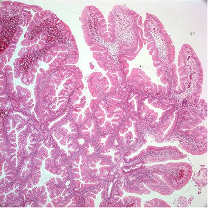 Traditional serrated adenoma. This polyp is composed of villiform... | Download Scientific Diagram