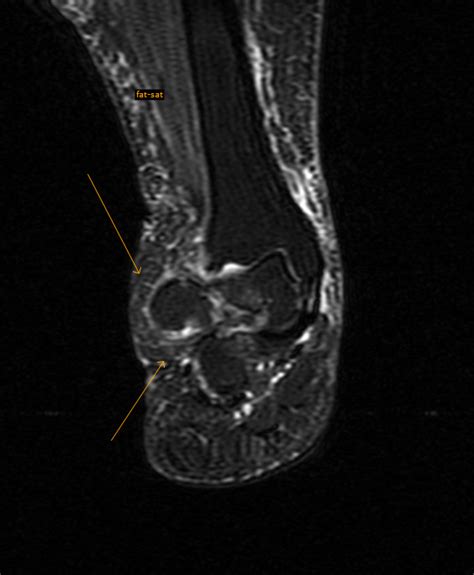 ON - RADIOLOGY: Lipoma arborescens of Ankle MRI (what`s that !!!)