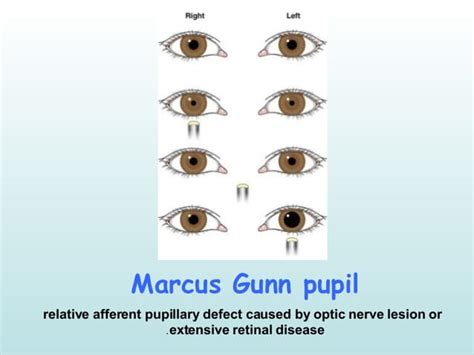 MARCUS GUNN PUPIL Marcus Gunn... - Being an Optometrist