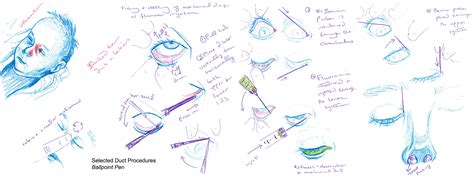 Nasolacrimal Duct Probe and Irrigation Sketches – Catherine Roop