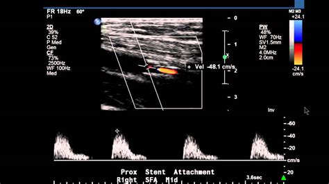 Excelente Horror admiración vascular duplex dedo privado Sillón