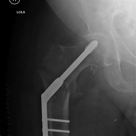 Photograph of positioning of the patient on the fracture table with ...