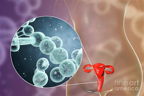 Candida Albicans Infection In Female Photograph by Kateryna Kon/science ...