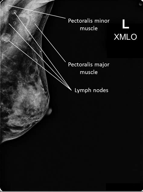 Mammogram - Screening, Diagnostic, 3d - Guidelines & Age